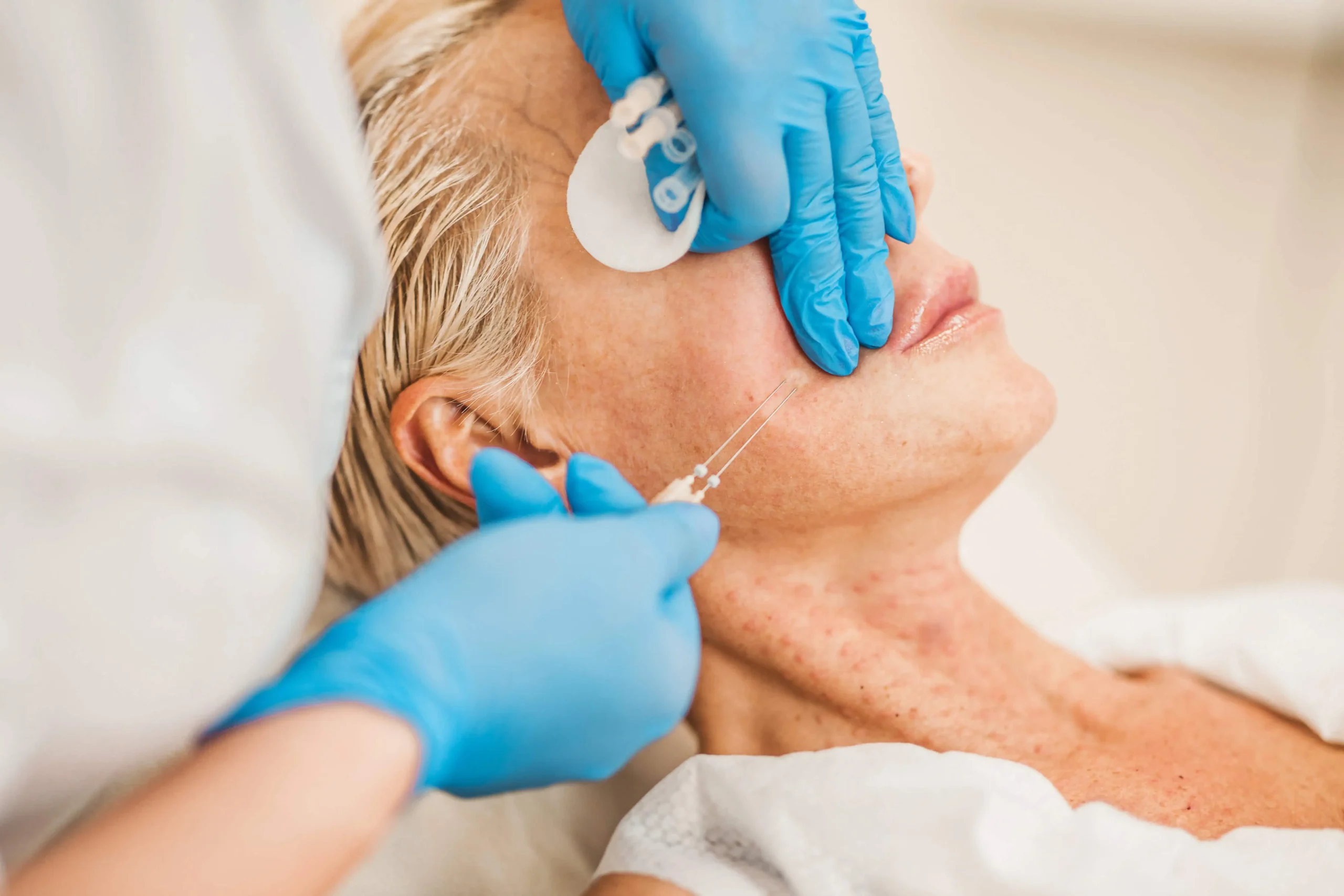 PDO thread lift in San Francisco, CA