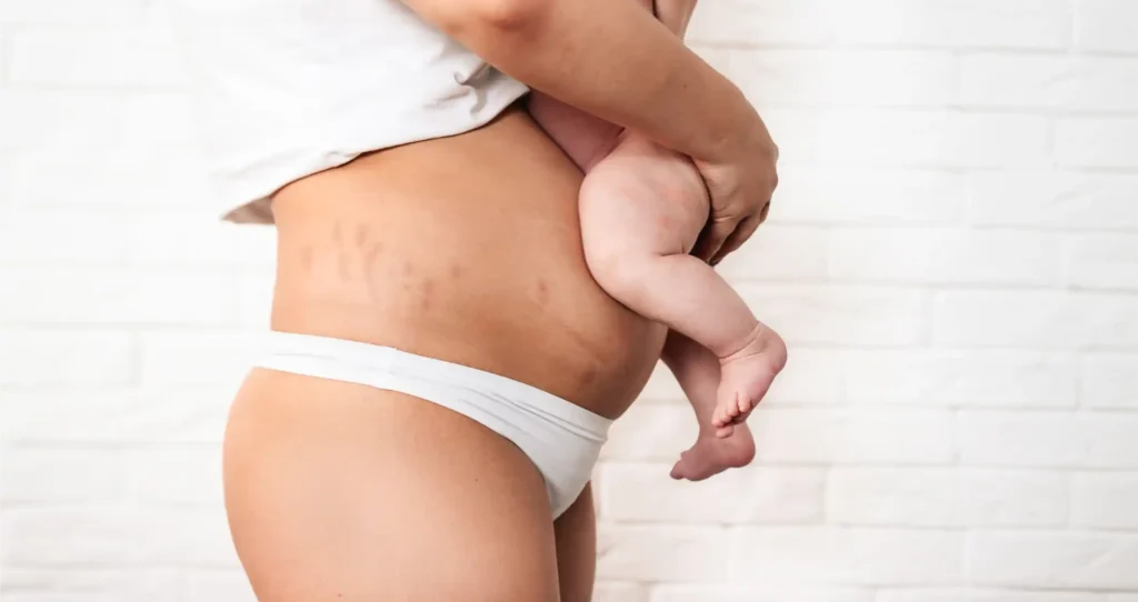 Woman holding a baby while showing postpartum stretch marks and stomach changes during recovery at Selfishly Aesthetics in San Francisco, CA