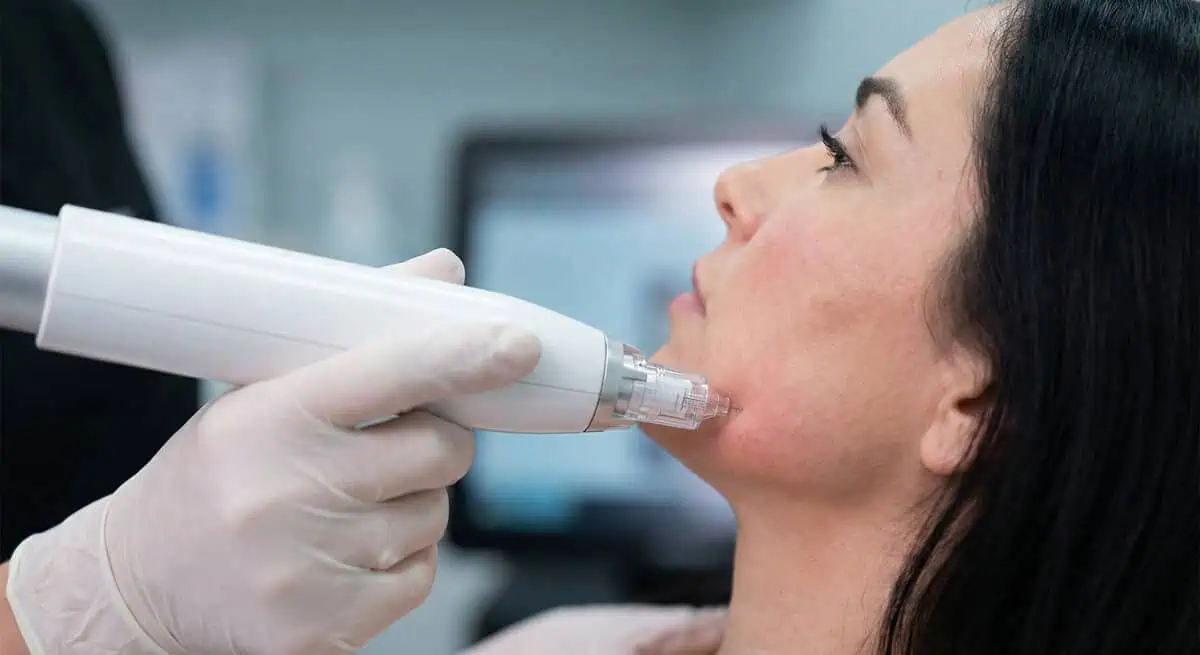 Provider performing RF Microneedling treatment to improve loose skin and stimulate collagen at SELFishly Aesthetics & Wellness Medical Spa in San Francisco, CA